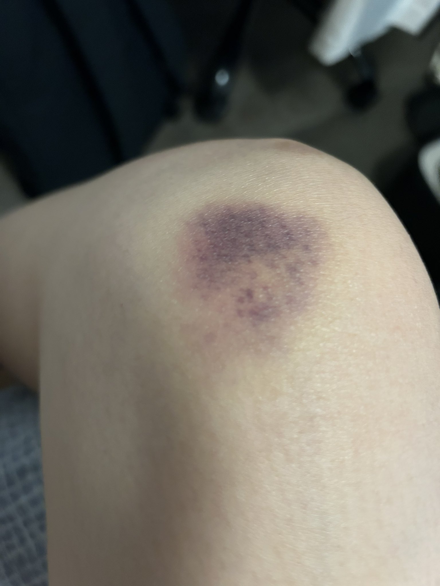 Carmen bruises from APEC 2.jpeg